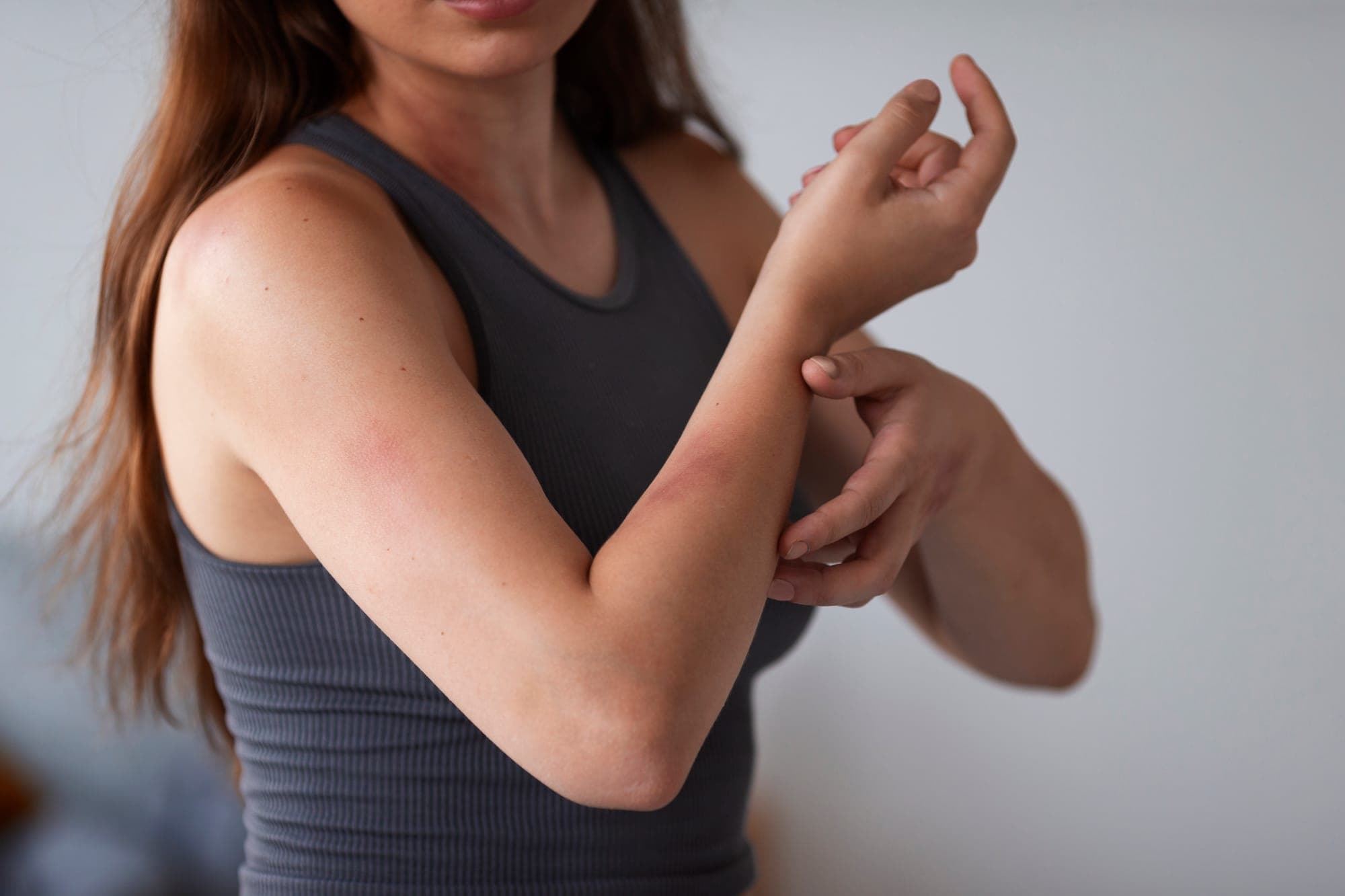 Urticaria por estrés: conoce más sobre esta alergia nerviosa